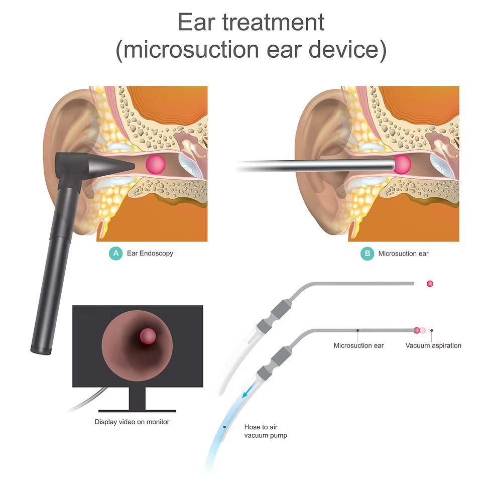 Hearing Aid Fitting at Miracle Hearing Clinic, Delhi