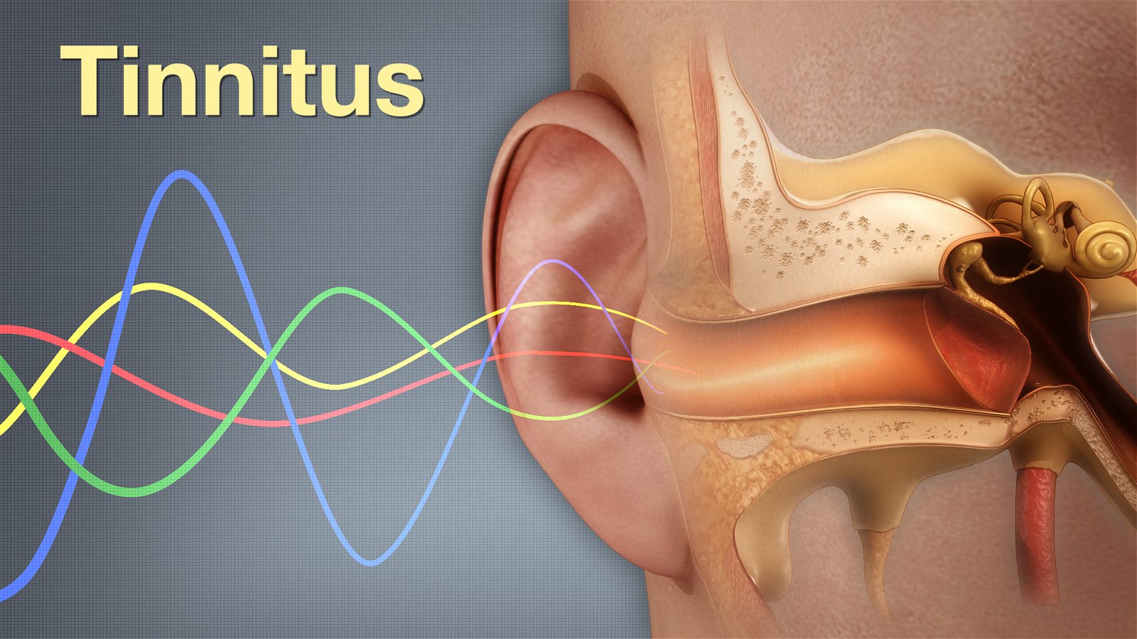 Tinnitus Management at Miracle Hearing Clinic, Delhi